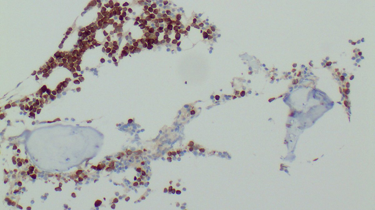 Charité - Universitätsmedizin Berlin (@chariteberlin) on Twitter photo After 20 years of preliminary research in the labs of <a href="/MDC_Berlin/">Max Delbrück Center</a> & #CharitéBerlin, a new T-cell immunotherapy against #MultipleMyeloma is now in clinical trials. The innovative treatment is designed to teach the immune system to fight the cancer cells. charite.de/en/service/pre… After 20 years of preliminary research in the labs of <a href="/MDC_Berlin/">Max Delbrück Center</a> & #CharitéBerlin, a new T-cell immunotherapy against #MultipleMyeloma is now in clinical trials. The innovative treatment is designed to teach the immune system to fight the cancer cells. charite.de/en/service/pre…