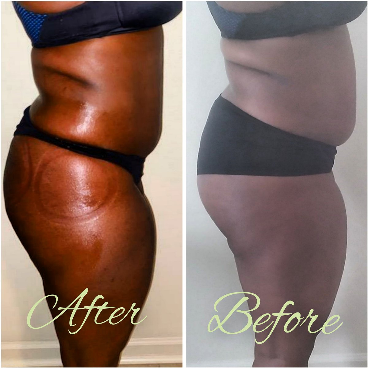 Call_ItME's tweet image. Lipo Cavitation + Vacuum Buttlift Therapy 
Hello Ladies! I am now offering Body Contouring services on camp I need 5 Models‼️ Special Pricing &amp;amp; Inquiries included. DM Or Text 678-949-4236 for more details and pricing! 
#SSU #SSU20 #savannahhairstylist #savmua #bodytransformation