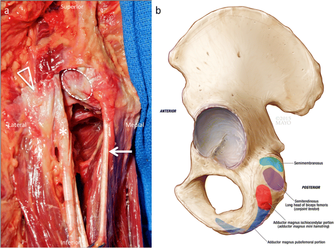 Also for the same PHT paper consider Adductor Magnus pathologies in Diff Diagnosis. 
<a href="/PhysioNetwork/">Physio Network</a> 

The adductor magnus “mini-hamstring”: MRI appearance and potential pitfalls | SpringerLink link.springer.com/article/10.100…