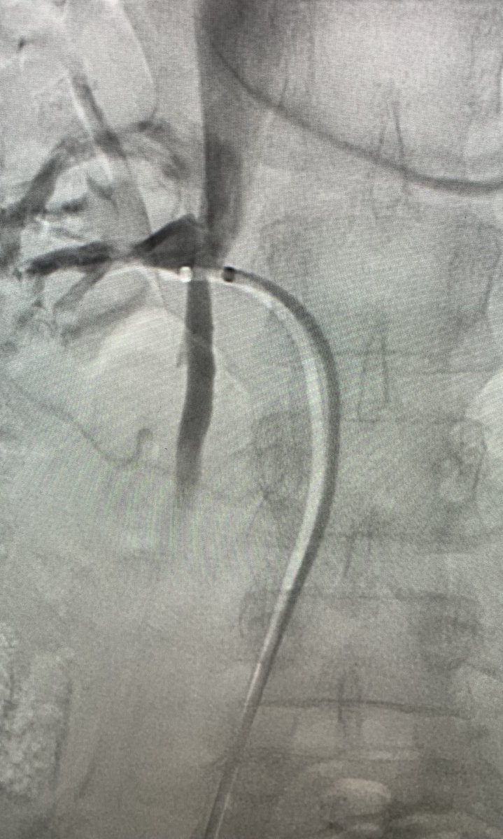 Type 4 Ronsivalle = shared confluence of renal vein and ovarian vein ⁦<a href="/joeirad/">Joe Ronsivalle</a>⁩ ⁦<a href="/masi_zachary/">zachary masi</a>⁩ ⁦<a href="/drochohan/">Omar Chohan, DO</a>⁩ ⁦<a href="/Safet_MD/">Safet Lekperic MD, RPVI</a>⁩ ⁦<a href="/LessneVIR/">Mark Lessne, MD</a>⁩ ⁦⁩ Not all right ovarians empty into the type 1 anterolateral IVC or type 2 lateral IVC or type 3 anterior IVC