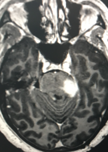 ARODMDPHD's tweet photo. #BrainTumorThursday Recurrent GBM in the pons.  One of the first cases in which I used #gleolan (a dye that makes the tumor glow in the dark). Very helpful. https://t.co/BitXWBeXd5