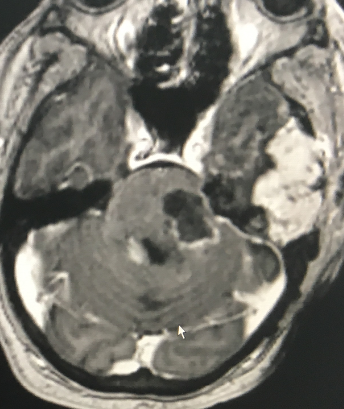 ARODMDPHD's tweet photo. #BrainTumorThursday Recurrent GBM in the pons.  One of the first cases in which I used #gleolan (a dye that makes the tumor glow in the dark). Very helpful. https://t.co/BitXWBeXd5