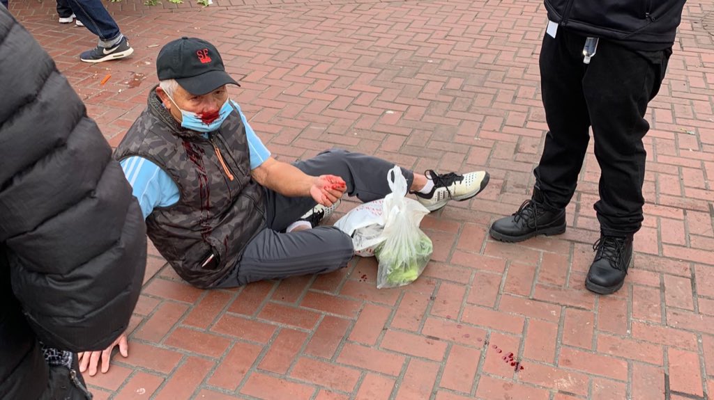 🚨𝗔𝗥𝗥𝗘𝗦𝗧 𝗶𝗻 𝗠𝗮𝗿𝗸𝗲𝘁 &amp; 𝟳𝘁𝗵 𝗦𝘁𝗿𝗲𝗲𝘁 𝗔𝘁𝘁𝗮𝗰𝗸𝘀 🚨
@sfpd have arrested Steven Jenkins. They say he assaulted 75-year old Chinese woman &amp; 83-year old Vietnamese man yesterday.
⠀
The man’s son sent me these pics. His fathers neck is broken in several places.