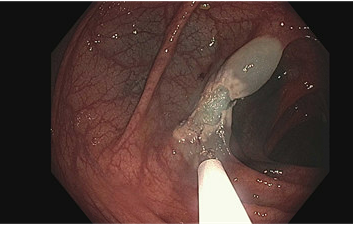 ScotDoug's tweet photo. First EMR (Endoscopic Mucosal Resection) today!  Thanks for a great day #MattMoyer! #TherapeuticEndo @PennStHershey https://t.co/wfNwT7AWtR