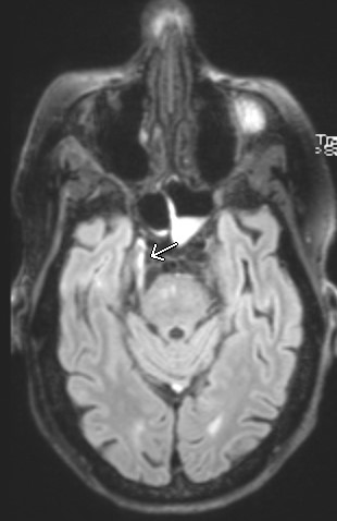 I have seen cranial neuropathy missed often enough that I'd like to remind everyone that every brain MRI is also a cranial nerve MRI. 

Case: multiple lung cancer metastases status post Gamma Knife SRS, with "right sided headache, eval for new mets".  #RadEd #HNRad #Neurorad