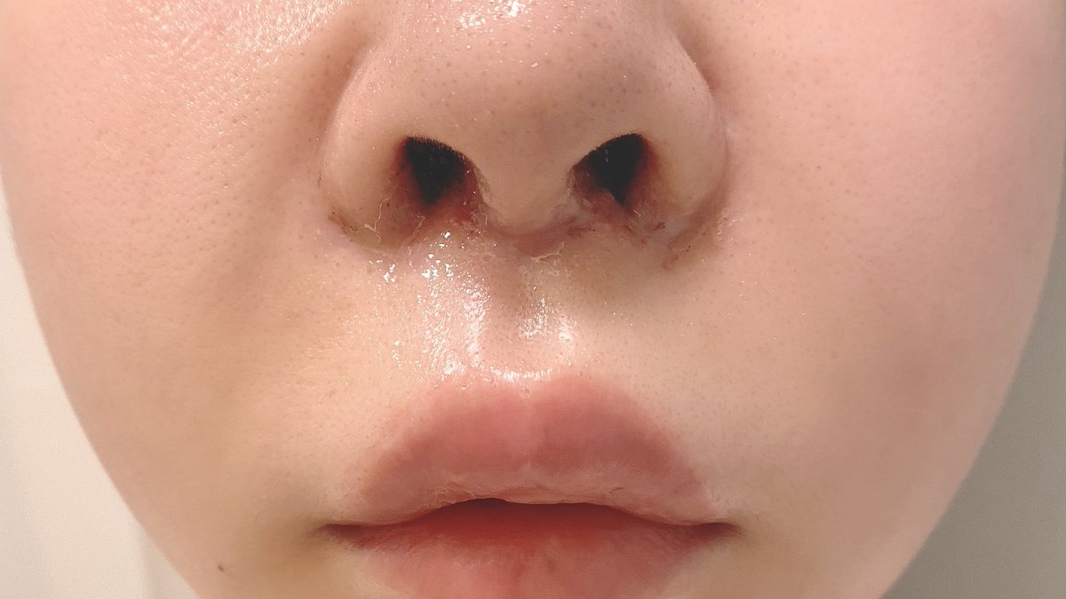 Kopurio 人中短縮day2 相変わらずのチョハッカイ腫れ 口が閉じないから上唇と歯茎の乾燥がひどい 軟膏のおかげで血液汚れが取れて来て 糸透明だから一見鼻の下縫ってあるの分からなくなって来た ダウンタイム中