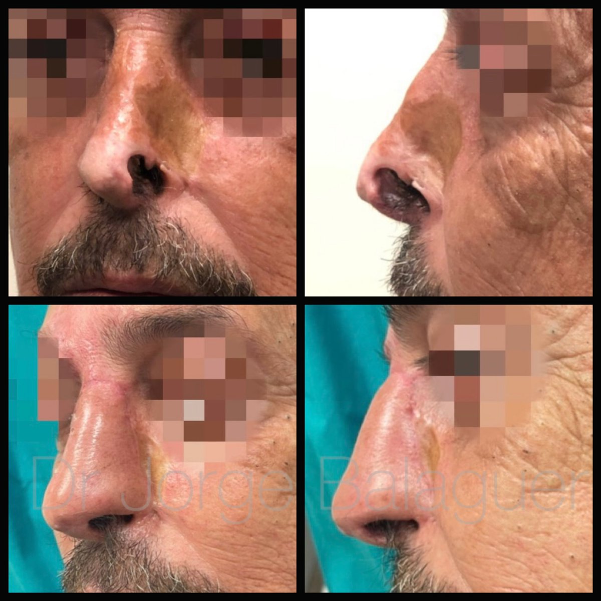 ClinicaBalaguer's tweet photo. Reconstrucción ala nasal con #COLGAJO FRONTAL con injerto concha auricular tras exéresis de un tumor basocelular #BCC 🏥 #newnose #hospitallafe #plasticsurgery 
...
📩 email: info@clinicadrbalaguer.com https://t.co/n17niJ0I91 https://t.co/aDSTZnR3XM