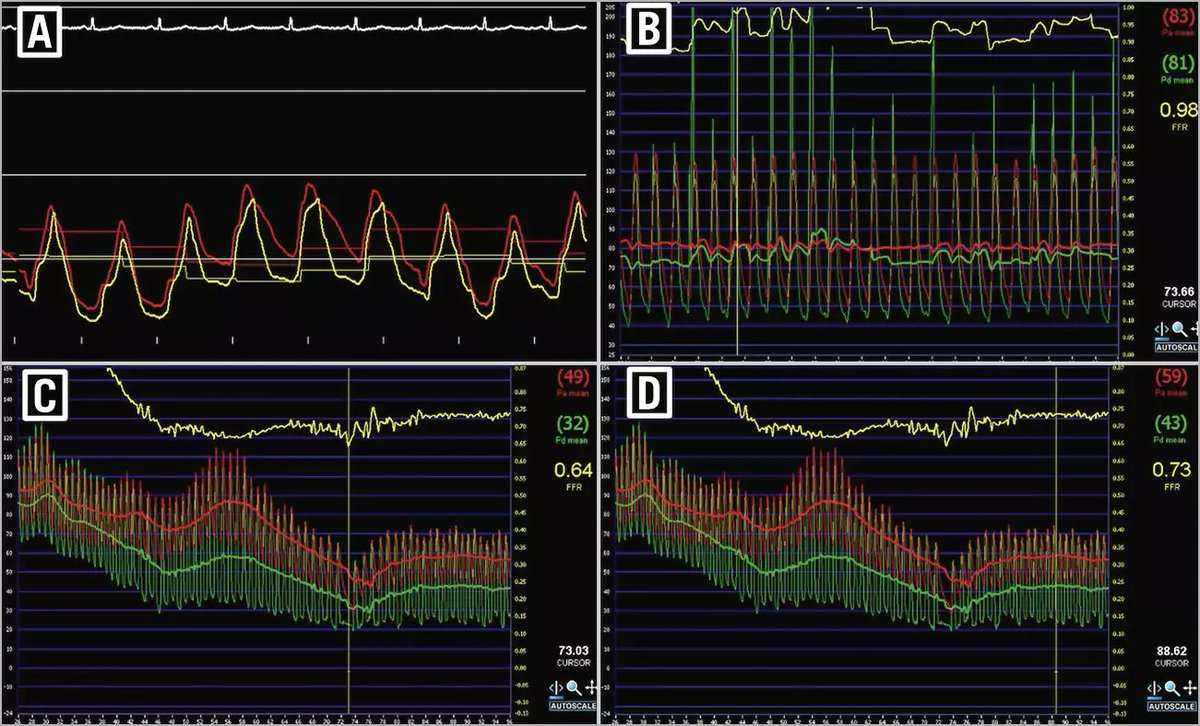 Recent data from randomised controlled trials have cast doubt upon the value of ischaemia testing to select patients for revascularisation. A state-of-the-art review on the transitioning role of invasive coronary physiology. eurointervention.pcronline.com/article/optimi…