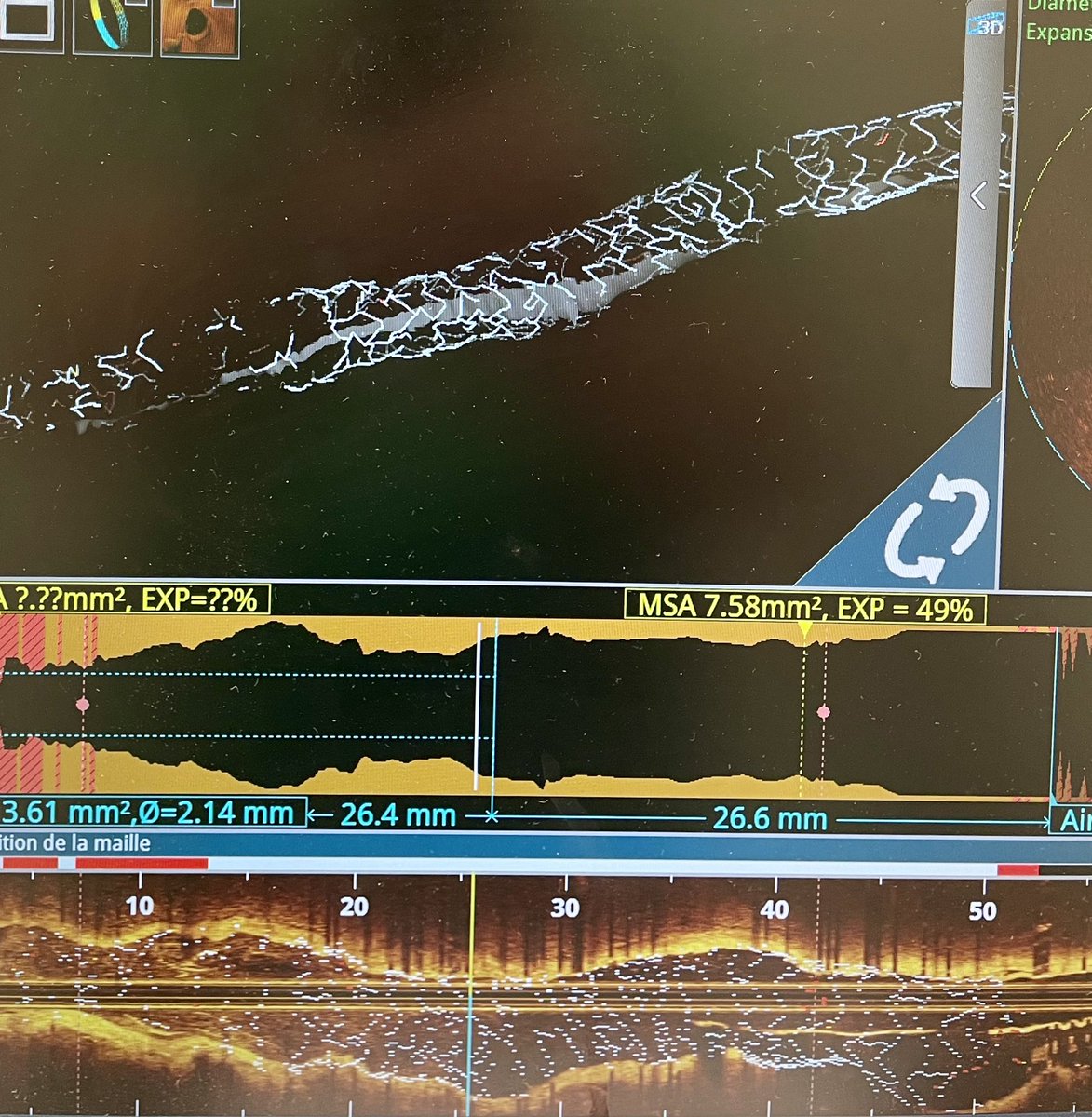 Severe under expansion DES treated by intravascular lithotripsy (shockwave 4.0) and 3.5 OPN NC balloon.
Procedure guided by OCT.
<a href="/deharo_pierre/">pierredeharo</a> <a href="/CuissetDr/">DrThomasCuisset</a>