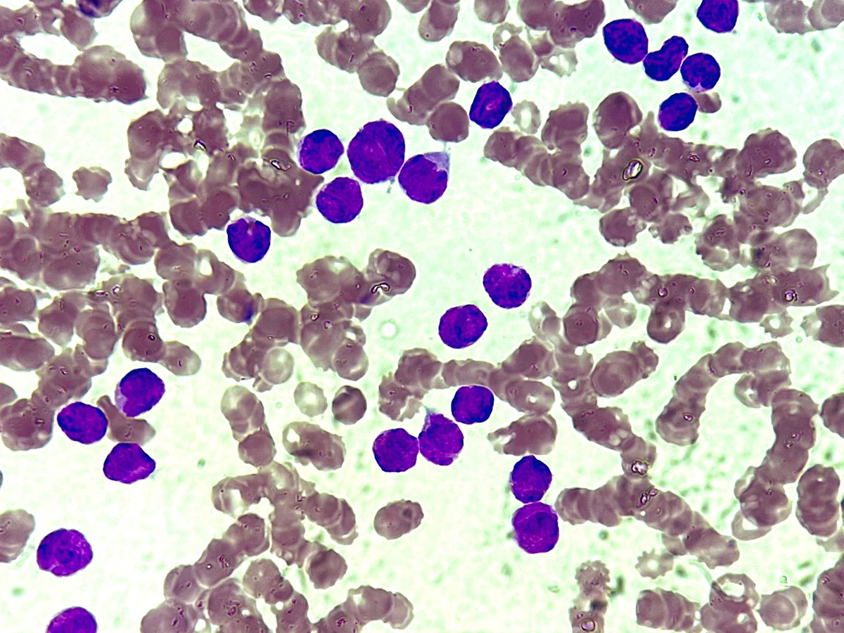 NidhinMd's tweet image. Lady in her early thirties, admitted with bleeding. Look at that MPO positivity!!   #twitterpath #PathTwitter #pathresident #pathology #hemepath #hematopath #hematology