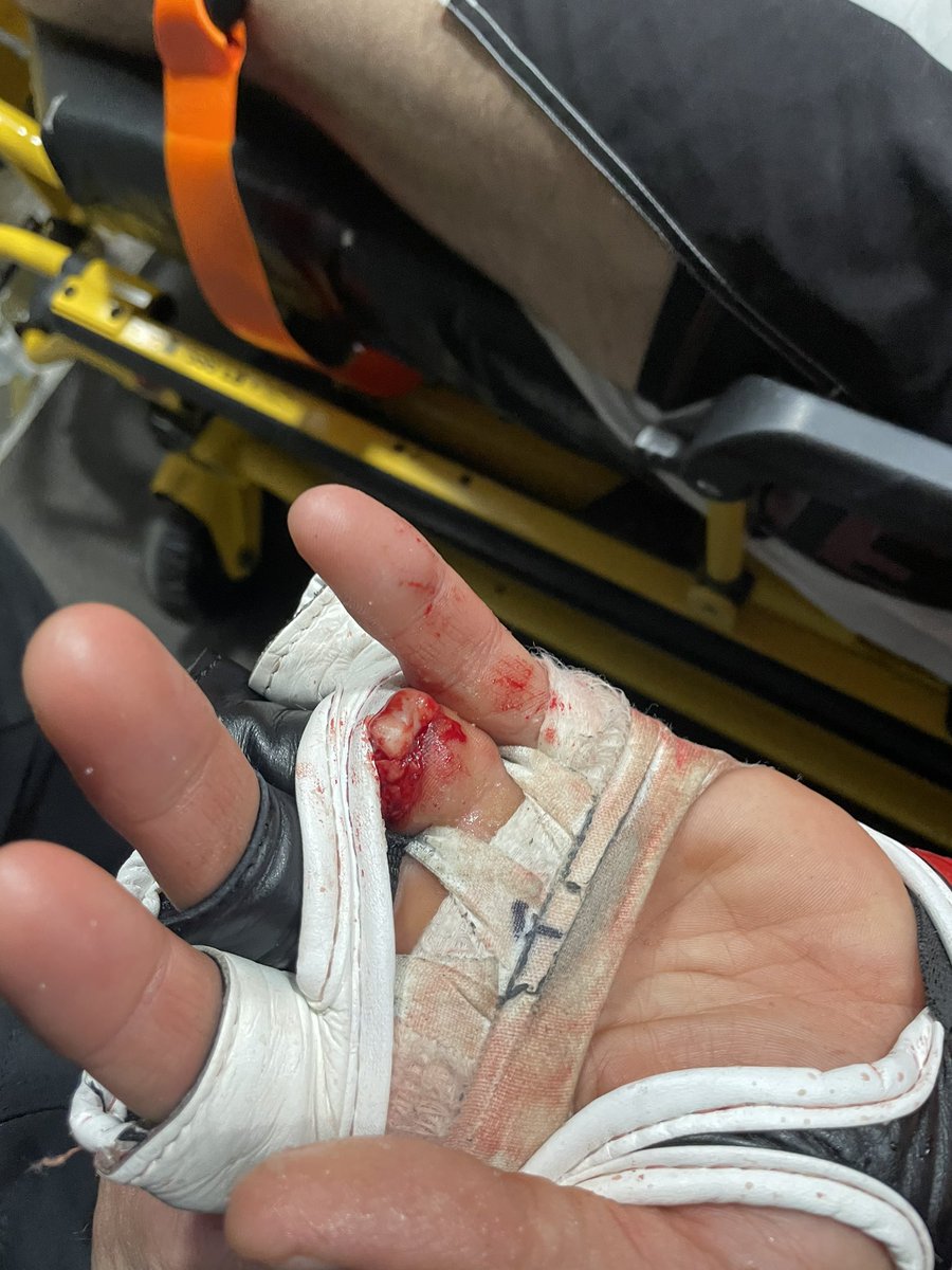 Pattersonfit1's tweet photo. So this happen to my fighter last night and he tried to hide it so they wouldn’t stop the fight ! Khetag Pliev might be the toughest person on the planet, sign this guy  ! @JonnyBones didn’t this happen to your toe ? 🤦🏽‍♂️💪🏽🥊 #findkhetagfinger #mma #fight #ufc @danawhite https://t.co/chajaj64r7