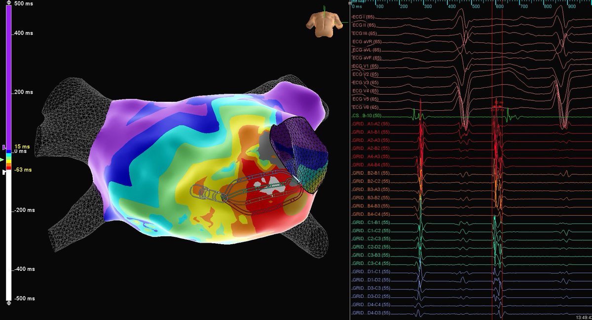 One of my favourite applications of the #HDGrid, perfectly bracketing a focal arrhythmia. Patient presented with PACs and short salvos of tachycardia that was terminated with a single ablation lesion. #ProudtobeAbbott #EPeeps <a href="/AbbottCardio/">Abbott Cardiovascular</a> <a href="/glover_benedict/">Benedict Glover</a> <a href="/SkobicDragana/">Dragana Skobic</a>