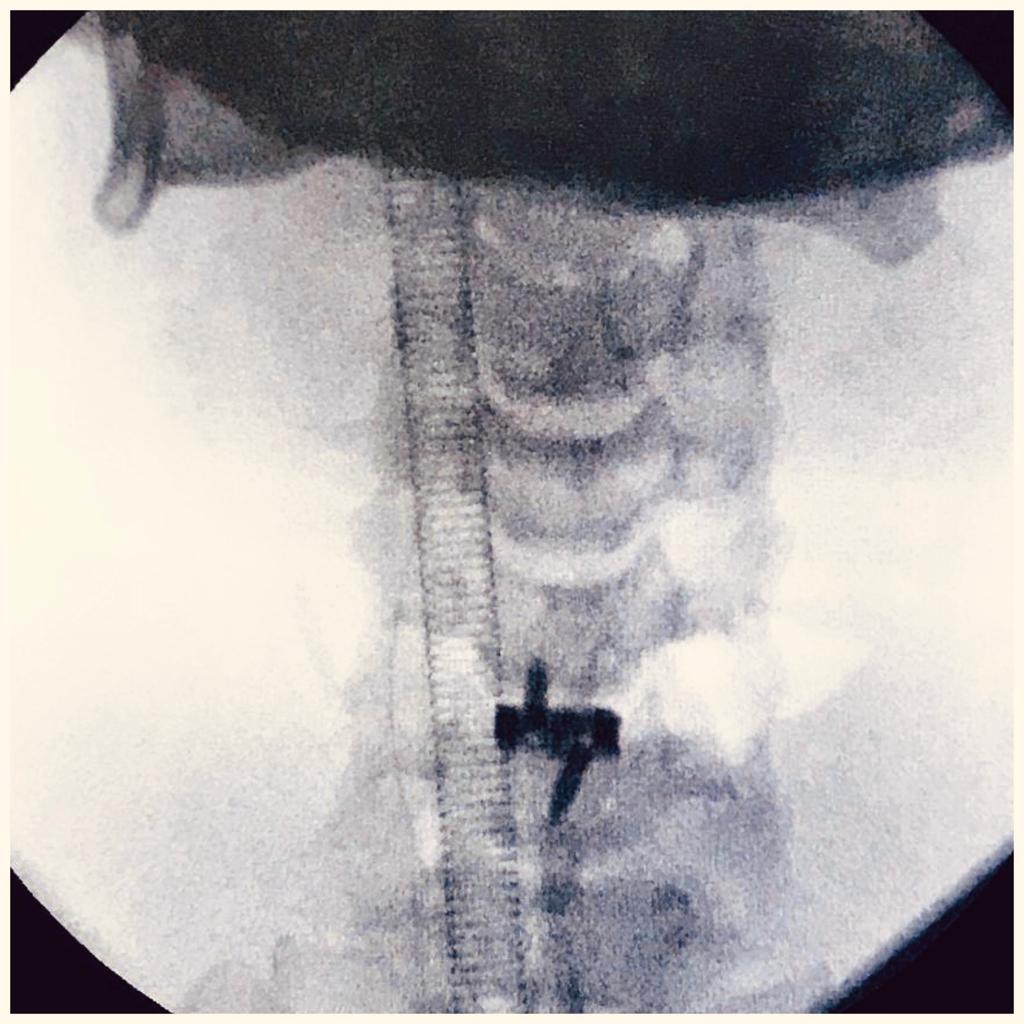 Surgery performed in Malaysia on 31 March 2021. Patient treated with Titanopeek Titanium Cage. #health #doctor #treatment #medical #surgery #todayssurgery #scopy #postop #osimplant #spine #spinehealth #spinemobility #stabilisation #fixation #cervical #postoftheday #spineimplants