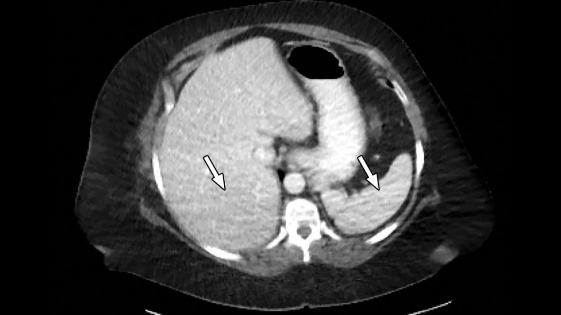 RadioGraphics's tweet photo. Radiologists and technologists should be aware of technological principles that may cause artifacts at dual-energy CT so that they can apply strategies to mitigate their occurrence and avoid diagnostic misinterpretation. https://t.co/PKxrG3RlmR #RadRes #ImagingPhysics https://t.co/0SXLquY4Ms