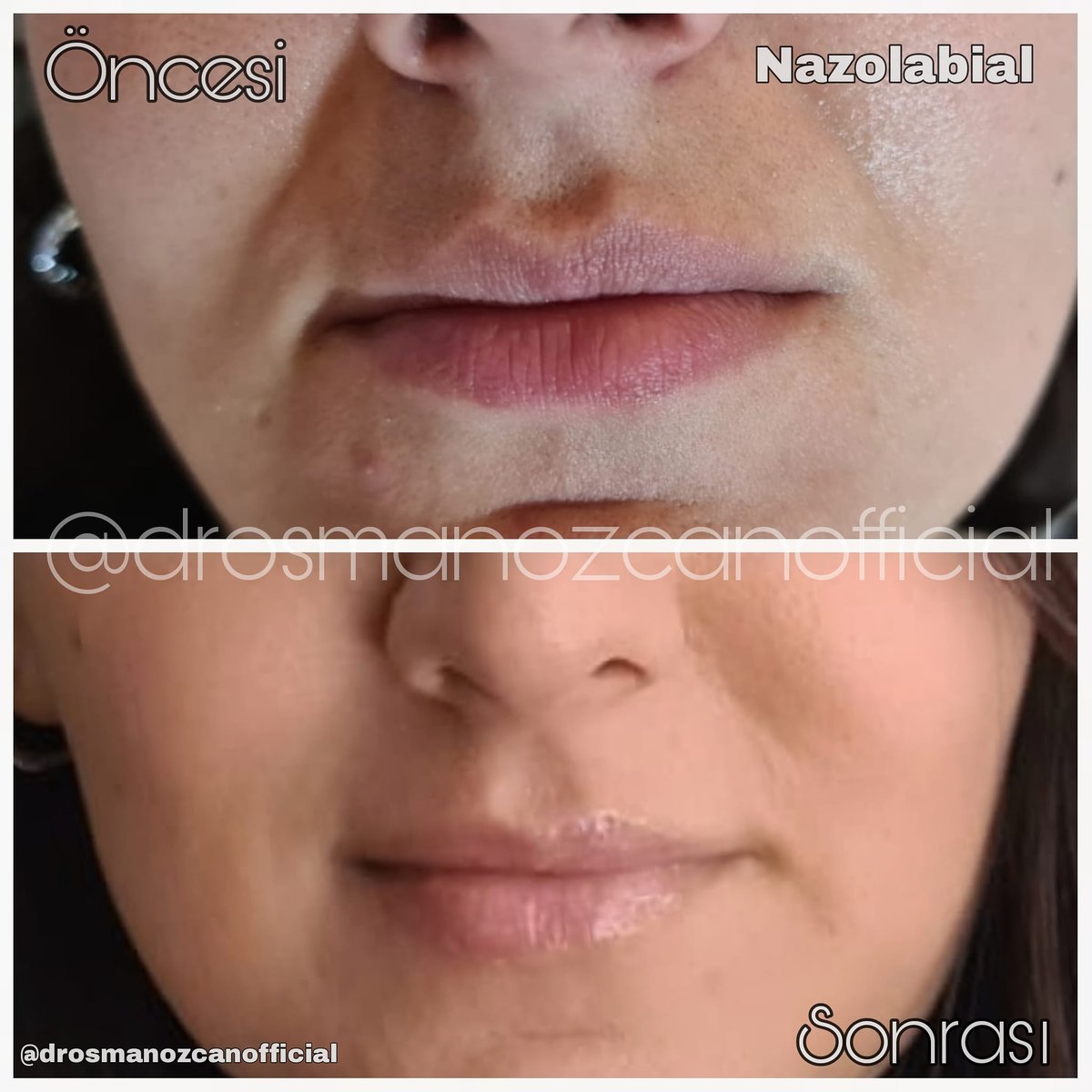 drosmanozcan's tweet photo. ❤ Merhaba arkadaşlar. #Nazolabial Dolgu yaptığımız hastamızın, hemen operasyon sonrası durumu ve bir hafta sonraki sonucu sizce de dikkat çekici değil mi?

❤ Hastamızın gelişimini buradan paylaşacağız. Lütfen takipte kalın.
 💙 Güzellik büyük bir zenginliktir. 
👉 #estetik https://t.co/v1W7spByUc