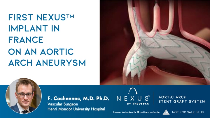 EndospanLtd's tweet photo. Professor F. Cochennec, Vascular Surgeon at the Henri Mondor University Hospital, Paris, France has implanted for the first time in France a NEXUS endoprosthesis. Congratulations to the entire surgical team! #aorticaneurysm #NEXUSaorta #totalarch #bridgingthegap #thoracicAA https://t.co/6cc1bD8OuE
