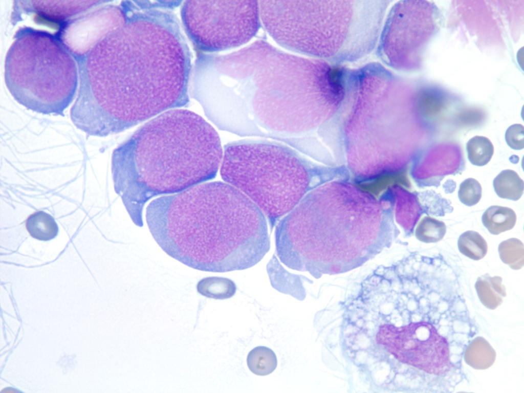 mesothelioma in cytology