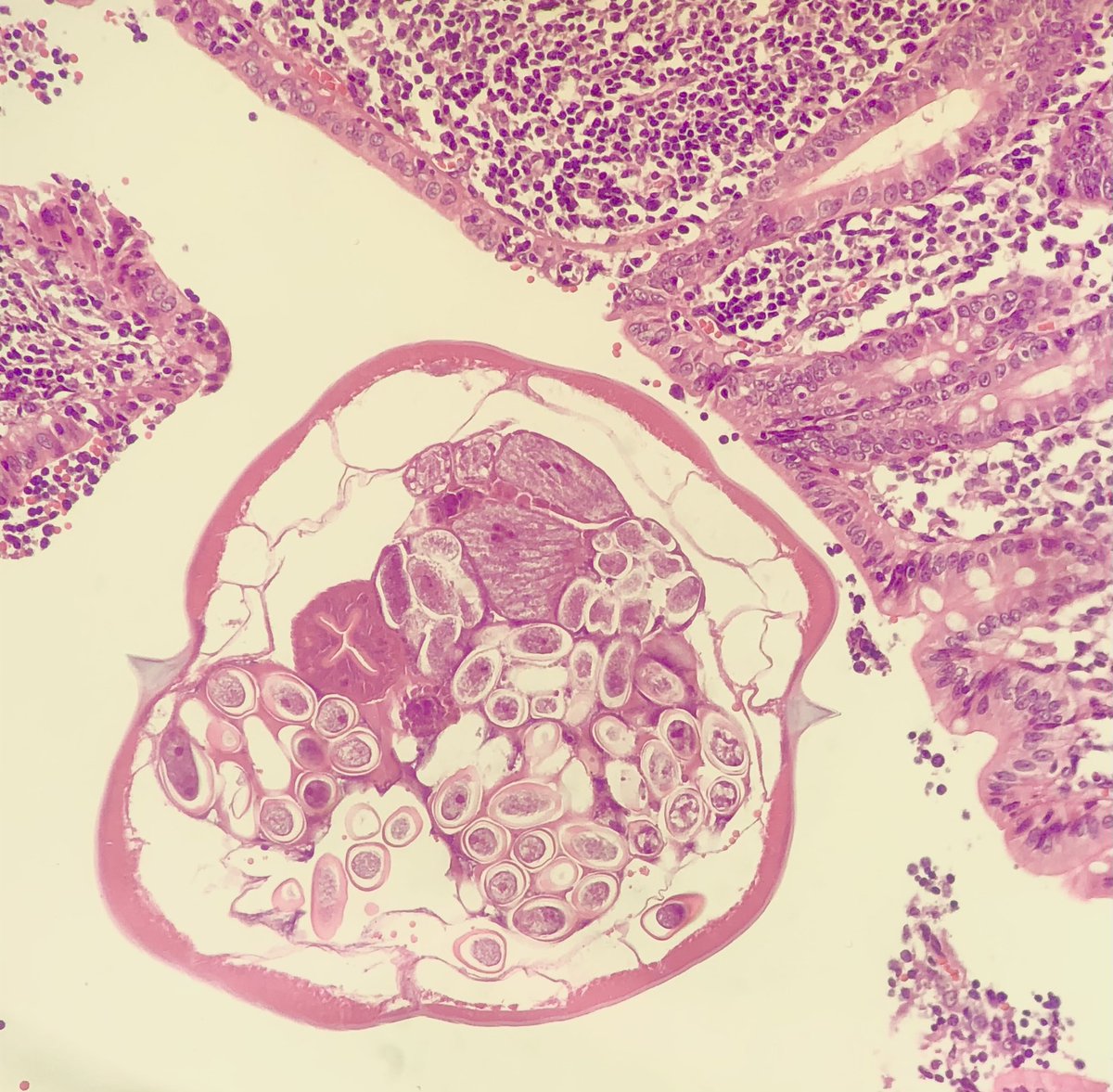These appendix just keep choosing my routines! Male, 4 yo, “appendicitis”. You know the drill... knock knock who’s there? 👀 #knockknock #crittersontwitter #pathbugs #appendix #pathology #pathresidents