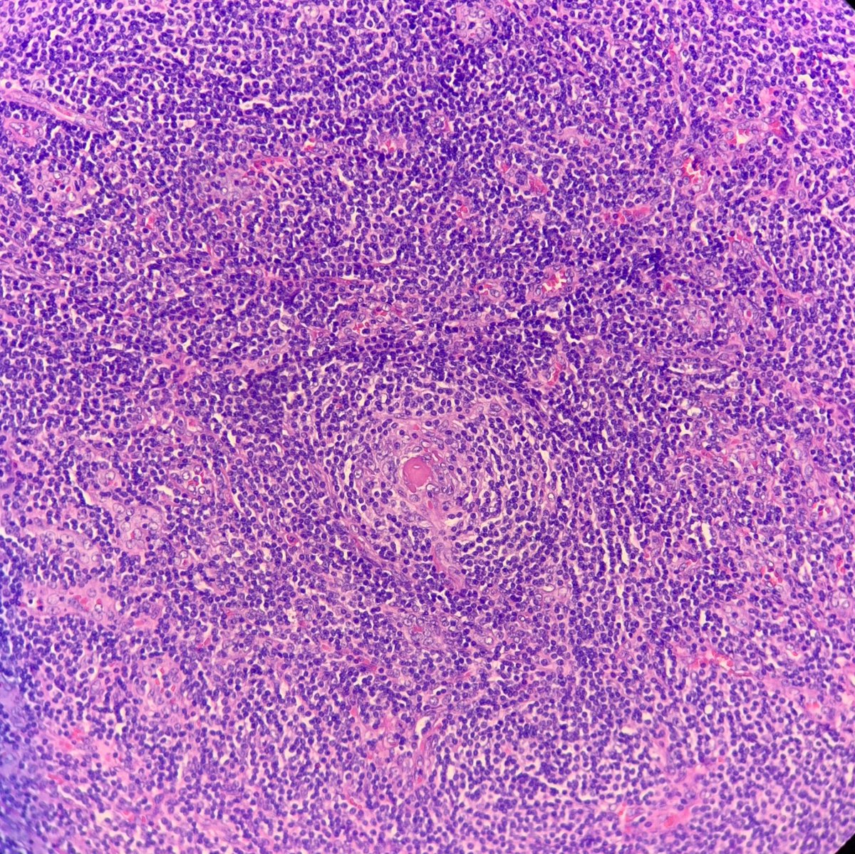 JuliaSrtt's tweet photo. Tiny lollipop 🍭 / Hyaline-Vascular variant of unicentric Castleman’s Disease #pathology #pathologyresident #anatomiapatologica #lollipop #lymphnode #hematopathology https://t.co/HkeFmi7OaN
