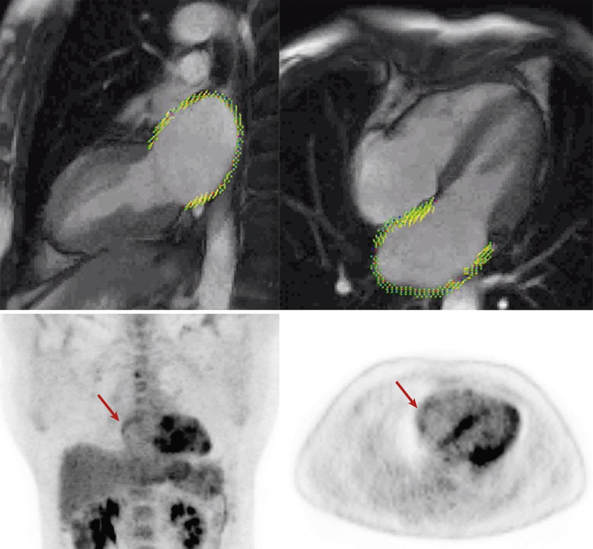 Jacc Journalsさんのツイート Can Multimodality Cvimaging Identify Cardiac Sarcoidosis Pts At Risk For Afib Whycmr Atrial Mechanical Dysfunction Atrial Fdg Uptake On Pet Are Associated W Afib In Cardiac Sarcoidosis T Co Rwygs3qnlo