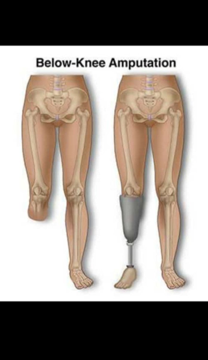 AdebisiOjo6's tweet photo. Incase you don't know
#Belowknee
#Prosthetics
#MedicalRehab. https://t.co/VmxpuNQIYk