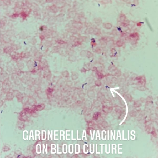 Ever seen Gardnerella vaginalis bacteremia in a male patient? @AkamineMD 's case presentation discussed this rare infection in males, most of which have a GU source, but endocarditis and empyema have been described in the literature. #IDtwitter