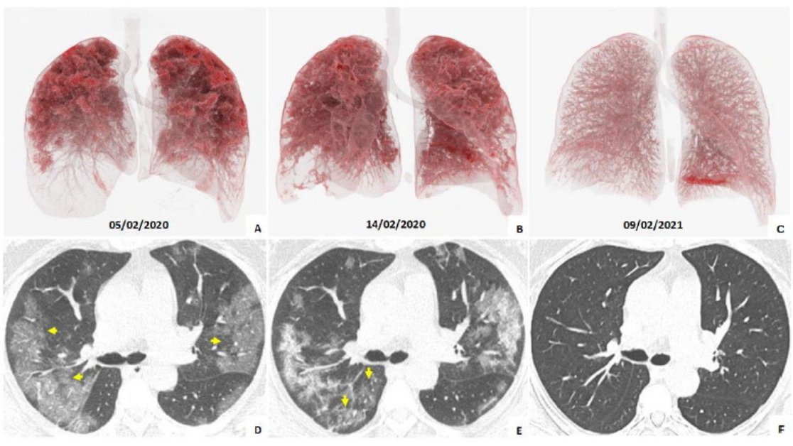 radiology_rsna's tweet photo. Published today in @radiology_rsna: One-year Follow-up after Severe SARS-CoV-2 Pneumonia. #COVID19 https://t.co/gbBPqc2mNp