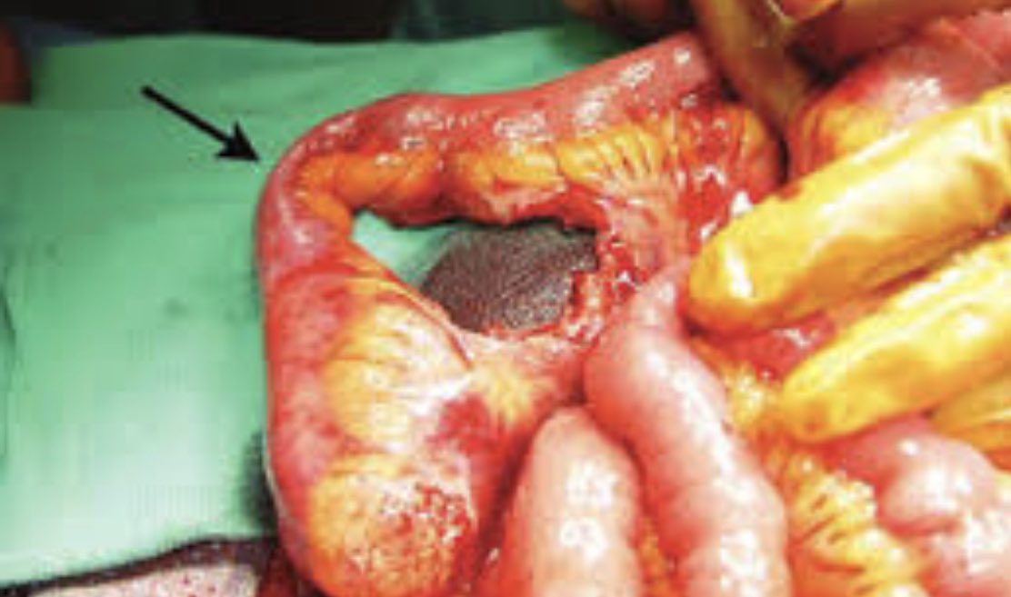 ChaseSurgical's tweet photo. Bucket handle injury to the bowel.Mechanism-sudden deceleration so commonly assoc with MVC’s. Often close to ‘fixed points’ of bowel - TI, proximal Jejunum, sigmoid.Devascularizing injuries and so resection is treatment. Any radiological tell tale signs?@rad_gi @SecretRadiology https://t.co/9QU7PDVDMK