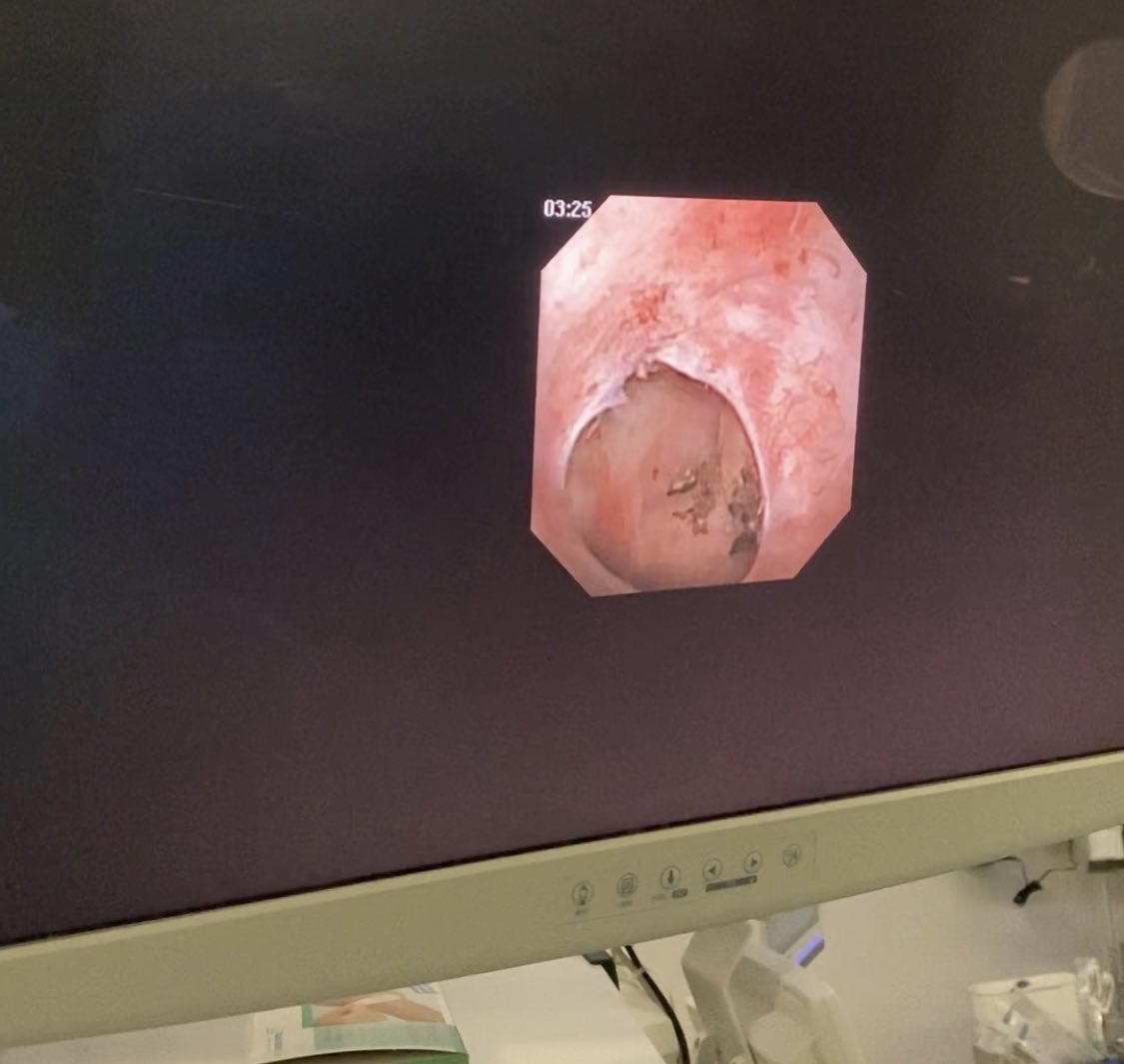 stojanmedical's tweet photo. Where did the stone go?
@PusenMedical flexible disposable ureteroscope
@lisalaseruro #RevoLixHTL https://t.co/3t2UphD1cI