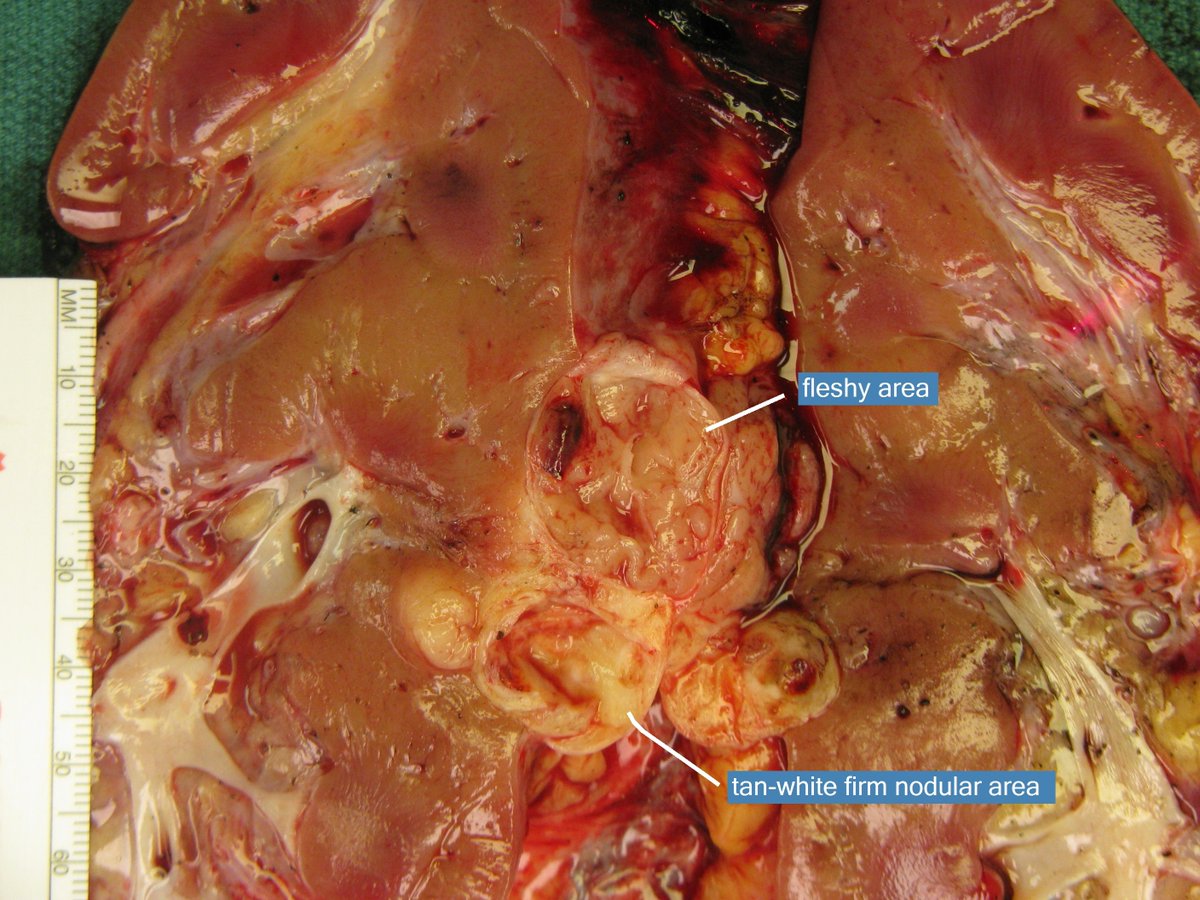 LaraHarikMD's tweet photo. Last day of #KidneyCancerAwarenessMonth inspired by @rovingatuscap #pathgross
This one is a real zebra!
#Pathfun #GUPATH #pathres #pathology #surgpath
(The annotations are just gross -slide legend correlation)
what is your diagnosis? https://t.co/8NpzraIG6y