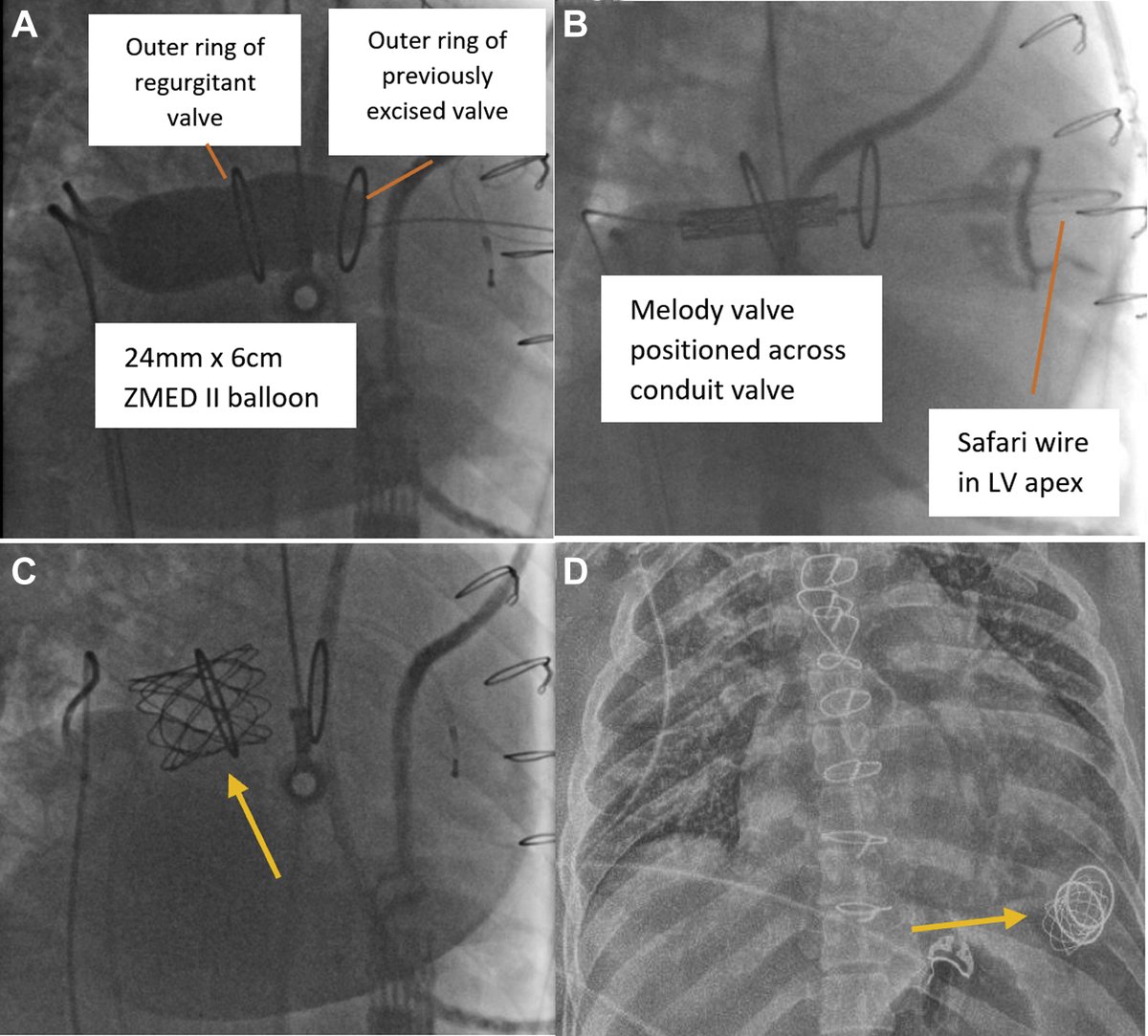 JACCJournals's tweet photo. Interesting case of severe bioprosthetic aortic stenosis and #apicoaortic conduit regurgitation treated with TF valve-in-valve #TAVR with Melody valve. https://t.co/96bj1vBSxE

#JACCINT #CardioTwitter #MedTwitter @PASistla https://t.co/GItT5f7ARq