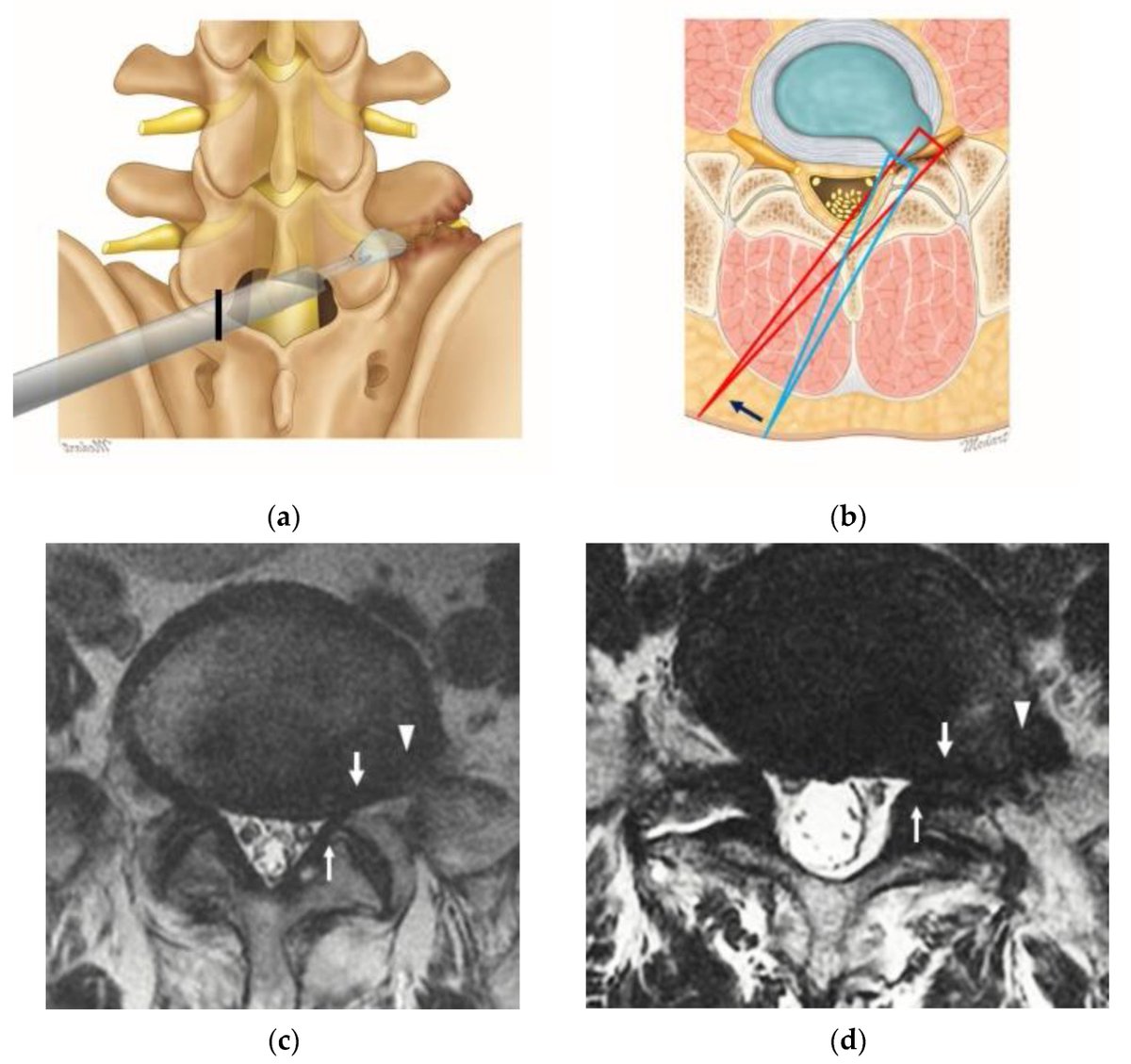 JCM_MDPI's tweet photo. #mdpijcm
“The Novel Technique of Uniportal #Endoscopic Interlaminar Contralateral Approach for Coexisting L5-S1 Lateral Recess, Foraminal, and #Extraforaminal Stenosis and Its Clinical Outcomes” by Ji Yeon Kim et al.
More info at https://t.co/SVsbv8t6dM https://t.co/W7qcZpXskM