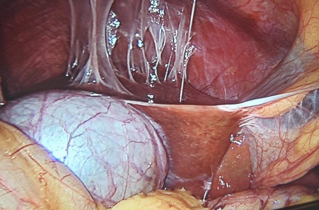 CiruAndes2's tweet photo. Image challenge by Dr @kelmvelx : what’s the cause of this adhesions? #SoMe4Surgery #MedTwitter @juliomayol @SWexner @pferrada1 @MISIRG1 @almagoch @DrThawaba https://t.co/EkeQONv38F
