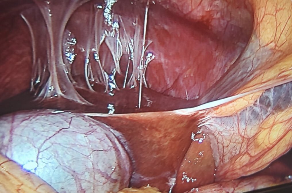 CiruAndes2's tweet photo. Image challenge by Dr @kelmvelx : what’s the cause of this adhesions? #SoMe4Surgery #MedTwitter @juliomayol @SWexner @pferrada1 @MISIRG1 @almagoch @DrThawaba https://t.co/EkeQONv38F
