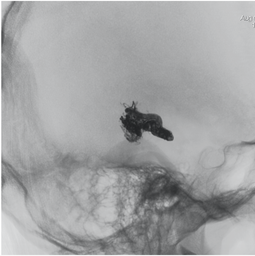 One of the most artistic procedures we perform:
Venous Pressure Cooker associated to arterial balloon to create aspiration effect... We can achieve beautiful results.