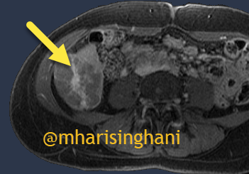 mharisinghani's tweet photo. Here is a lesion with delayed enhancement of scar, like in FNH but came back as fibrolamellar HCC https://t.co/UhXg4ffFK6