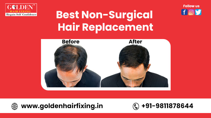 Golden Hair Fixing  Hair Replacement Service in Andheri West