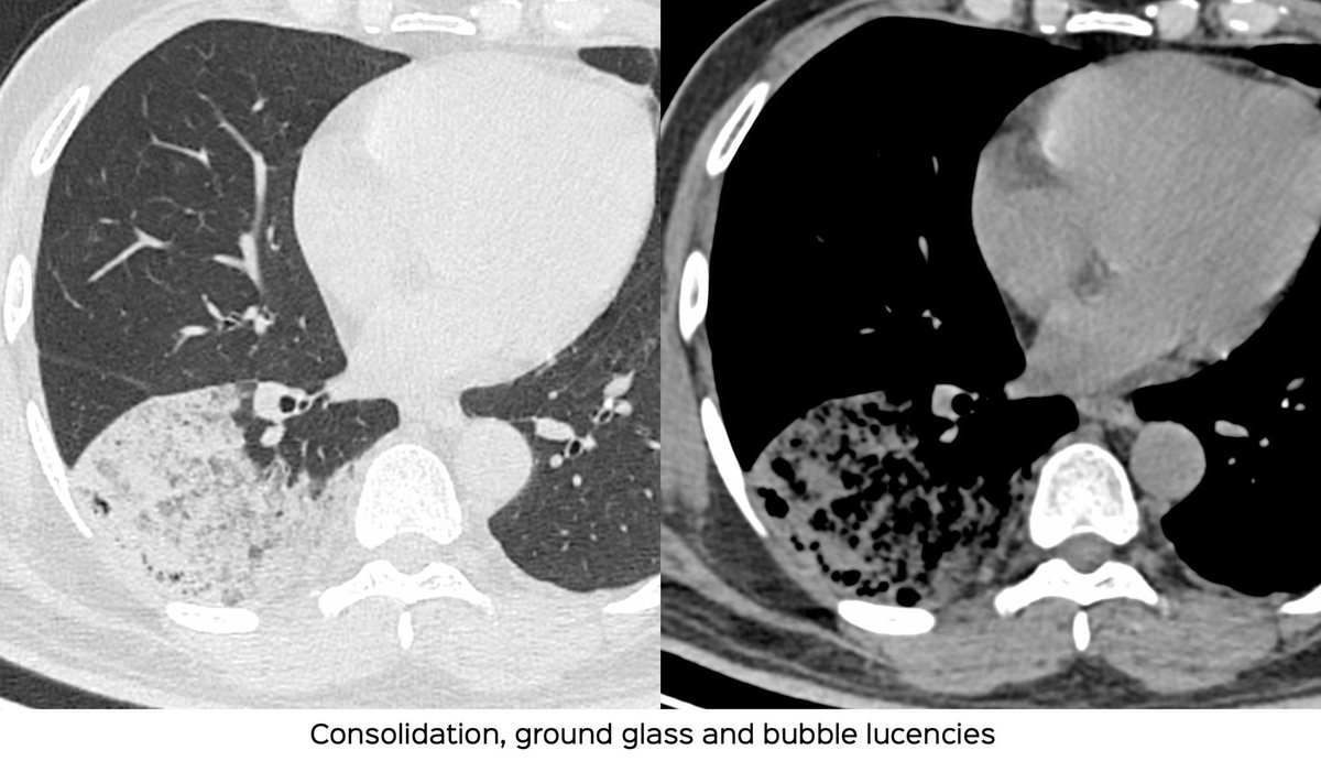Non-resolving consolidation and multifocal opacities in a 64-years old
ctchestreview.com/consolidation0…
#ctchest #medtwitter #lungtwitter #radres