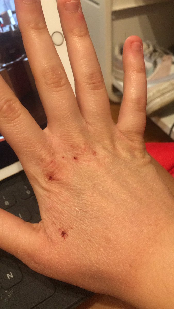CaterinaLuppin0's tweet photo. ecco cosa intendo quando dico che sono una 17enne nel corpo di una 90enne #acciacchi #vecchiaia https://t.co/GfpenFWK9L