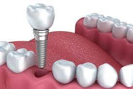plastic84656100's tweet photo. #ToothRegeneration
A regenerative medicine procedure based on stem cell in the field of tissue and biology of stem cell to rearrange the altered lost teeth by the regrowth from autologous stem cells.
interested can register here:https://t.co/tnx4XKKC0T
#Socket #Polyphyodont https://t.co/hywJEvbU4f
