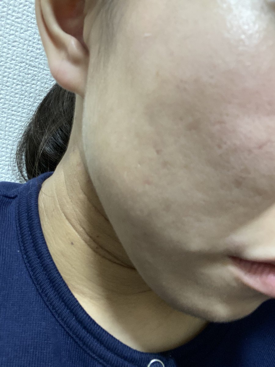 n08221527's tweet photo. 4ヶ月ほど経ったのかな？
至近距離ではまだまだだけど、普通に会話するくらいの距離なら綺麗に見えるようになってきました！
ゼビアックス（処方薬）、DUO（クレンジング）使用 https://t.co/I7BTjU0XiJ