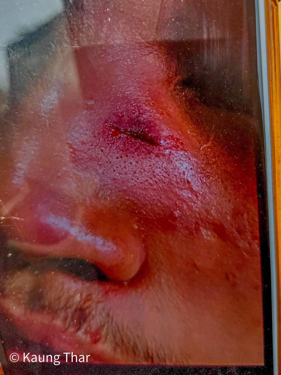 Jiyunnne's tweet photo. tw // blood
Due to brutal crackdown on Monywa strike, two more civillians were injured in the hand and nose respectively by 1pm.
SUPPORT FEDERAL ARMY 
#forceavote 
#MilkTeaAlliance 
#WhatsHappeningInMyanmar
#Apr1Coup https://t.co/iywsHnNnea