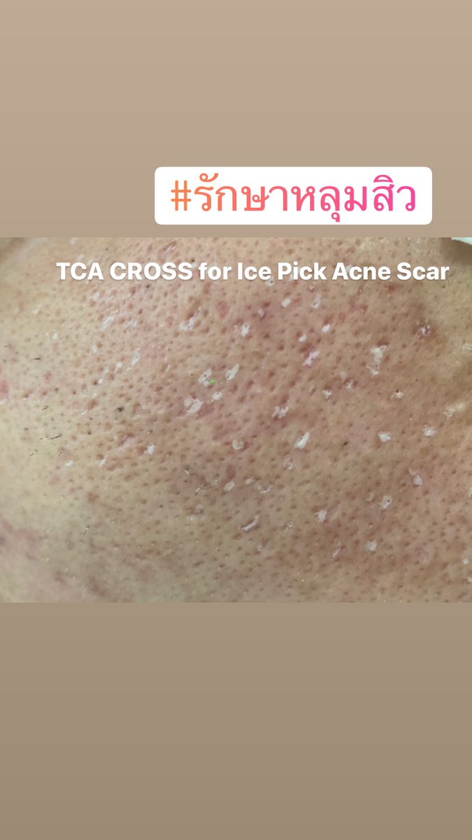 DrRuj1's tweet photo. #รักษาหลุมสิว #TCACROSS https://t.co/3X0iLT4BxV