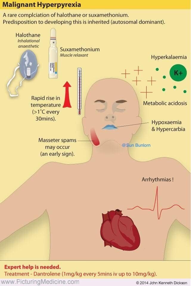 IhabFathiSulima's tweet photo. #Malignant #hyperpyrexia can occur in #autosomal #dominant #genetically predisposed individuals in response to ? https://t.co/wePpOXDnCO