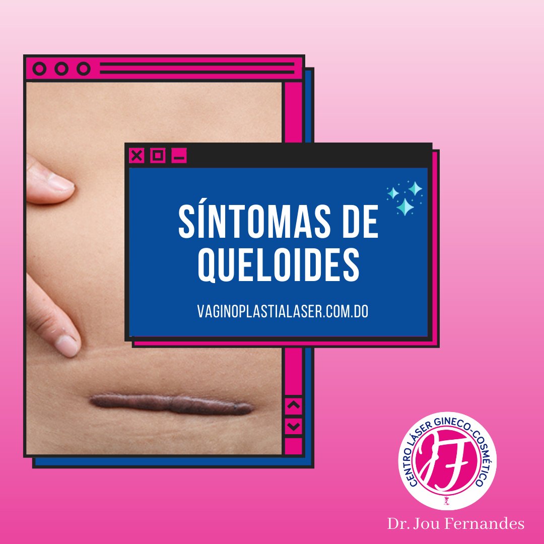 drjoufernandes's tweet photo. Los #queloides pueden tener las siguientes características: aparecen y crecen lentamente. Puede pasar de 3 meses hasta un año antes de que vea los primeros signos de un queloide, luego, lleva semanas o meses para que crezca. #JuevesSanto  #FelizJueves 
https://t.co/3hSytPhuN6 https://t.co/NwytUsjY1i
