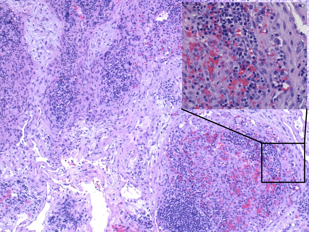 OHSU Pathology & Laboratory Medicine (@ohsupathology) on Twitter photo Young male with mesenteric adenopathy, lymph node excision with unremarkable flow cytometry. What’s the immunostain - Any guesses? We’ll post the answer and diagnosis soon #PathTwitter but is it #SurgPath or #Hemepath or something else??? <a href="/drdonnahansel/">Donna Hansel MD, PhD</a> @oliviasnir @pwraess Young male with mesenteric adenopathy, lymph node excision with unremarkable flow cytometry. What’s the immunostain - Any guesses? We’ll post the answer and diagnosis soon #PathTwitter but is it #SurgPath or #Hemepath or something else??? <a href="/drdonnahansel/">Donna Hansel MD, PhD</a> @oliviasnir @pwraess