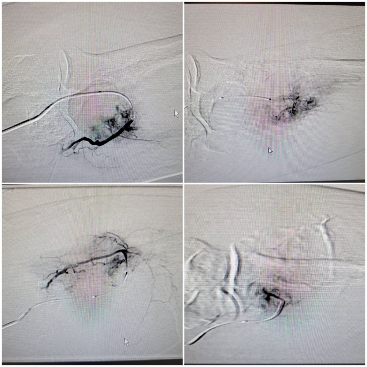 TempleRADs's tweet photo. Patient with metastatic RCC to ulna. Preop particle embo on multiple arterial branches. Successful resection arthroplasty done 1 day later. Sweet collaboration with @TempleOrtho! Great job Dr. Cuthbertson and @Nmontec2. @TempleRadRes @SIRspecialists @SIR_ECS @SIRRFS #IRAD https://t.co/UIWvURT1ZF