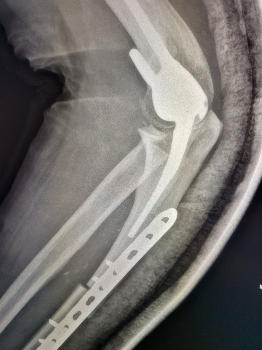 TempleRADs's tweet photo. Patient with metastatic RCC to ulna. Preop particle embo on multiple arterial branches. Successful resection arthroplasty done 1 day later. Sweet collaboration with @TempleOrtho! Great job Dr. Cuthbertson and @Nmontec2. @TempleRadRes @SIRspecialists @SIR_ECS @SIRRFS #IRAD https://t.co/UIWvURT1ZF