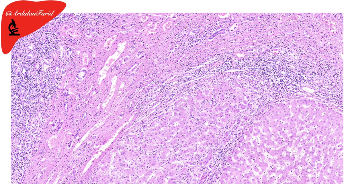 ArdalanFarid's tweet photo. A 44-year-old cirrhotic lady who underwent #liver #transplantation. What’s the #cause of #cirrhosis? What are the salient #histopathologic findings?
#PathTwitter 
#LiverPath
#TUMSpath
#quiz https://t.co/lCQhIfA7C5