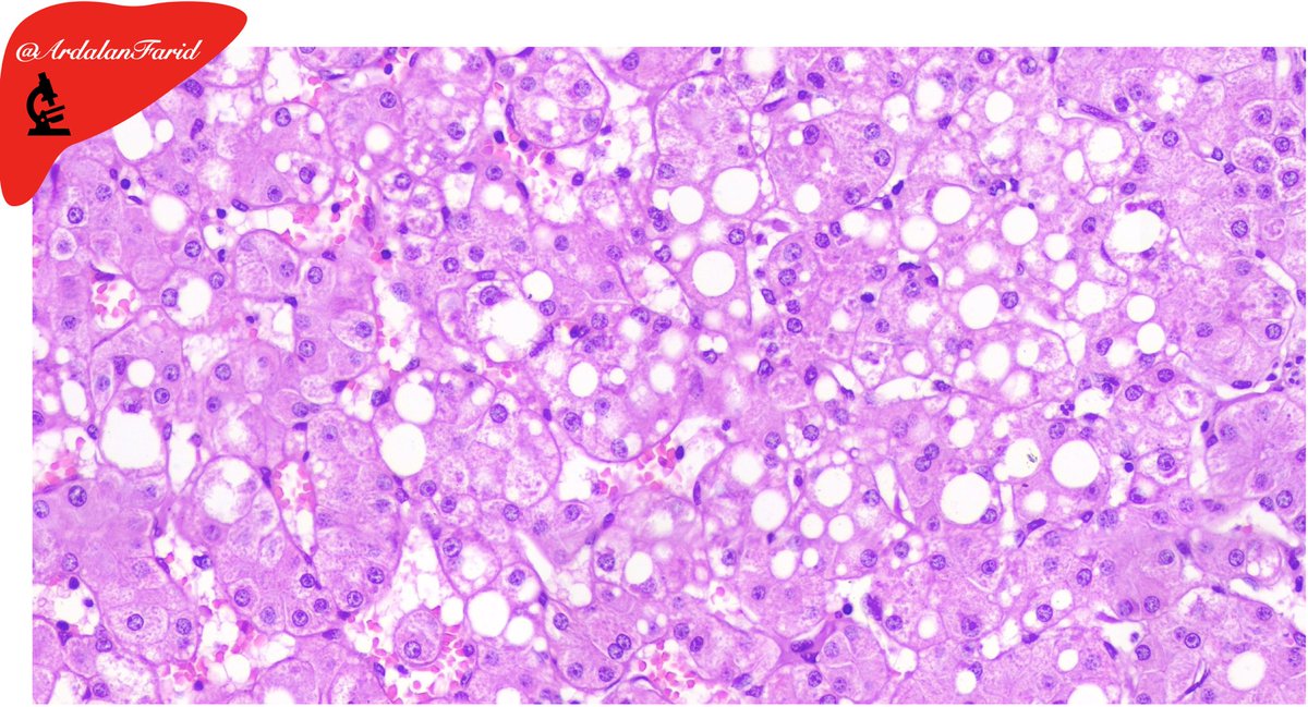 ArdalanFarid's tweet photo. A 44-year-old cirrhotic lady who underwent #liver #transplantation. What’s the #cause of #cirrhosis? What are the salient #histopathologic findings?
#PathTwitter 
#LiverPath
#TUMSpath
#quiz https://t.co/lCQhIfA7C5